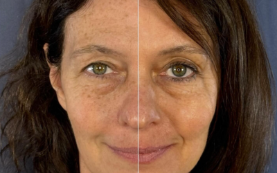 Antes y Después de Programa de rejuvenecimiento facial integral