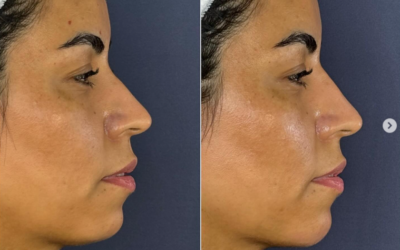 Armonización del 1/3 inferior facial en paciente con mentón pequeño